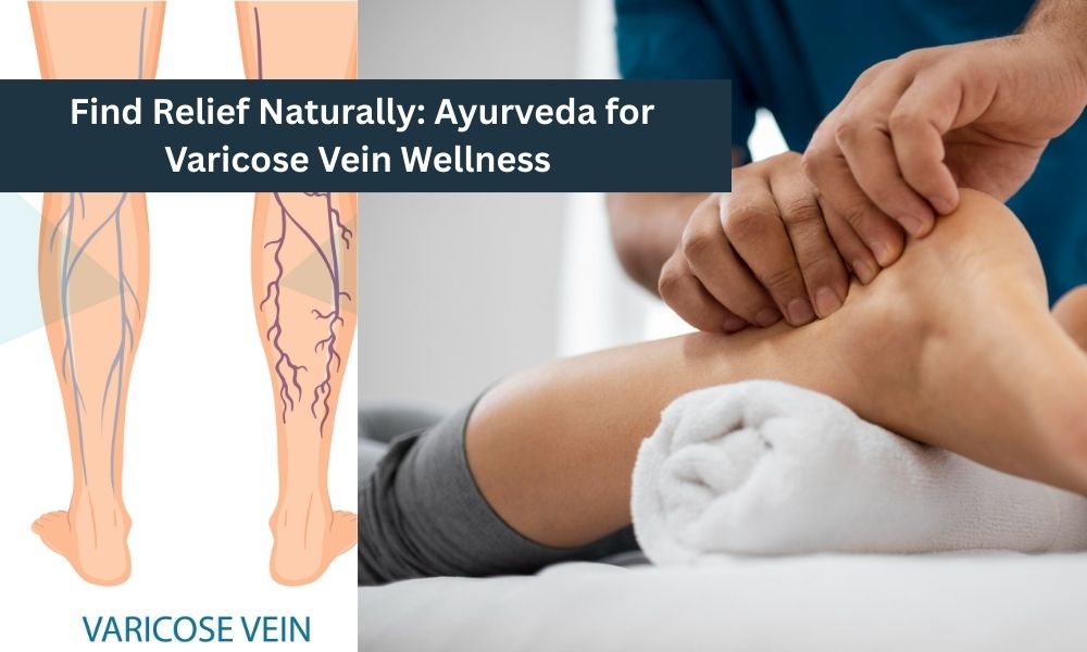 Varicose Veins Treatment in Ayurveda